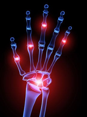 Researchers Uncover a Promising Link Between 5-HTP and Rheumatoid Arthritis