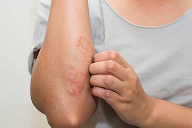 Solid Link Between Psoriasis and Vitamin D Levels Offers Hope for New Treatment Options
