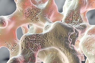 Osteoporosis in Men: An Important Yet Often Missed Disease