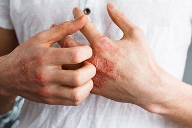 Using Probiotics for Eczema Can Help Heal Your Skin