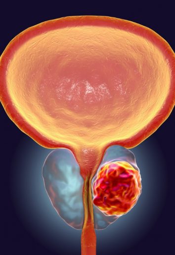 IBD and Prostate Cancer Linked, Says New Study 2