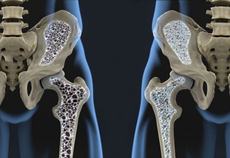 Scientists Find Link Between Osteoporosis and Quality of Social Life 1